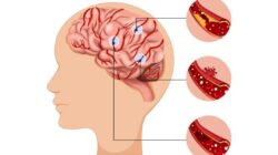 Dampak Sistem Rujukan terhadap Penanganan Pasien Stroke di Indonesia