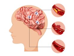Dampak Sistem Rujukan terhadap Penanganan Pasien Stroke di Indonesia