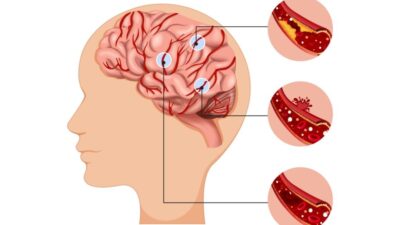 Dampak Sistem Rujukan terhadap Penanganan Pasien Stroke di Indonesia