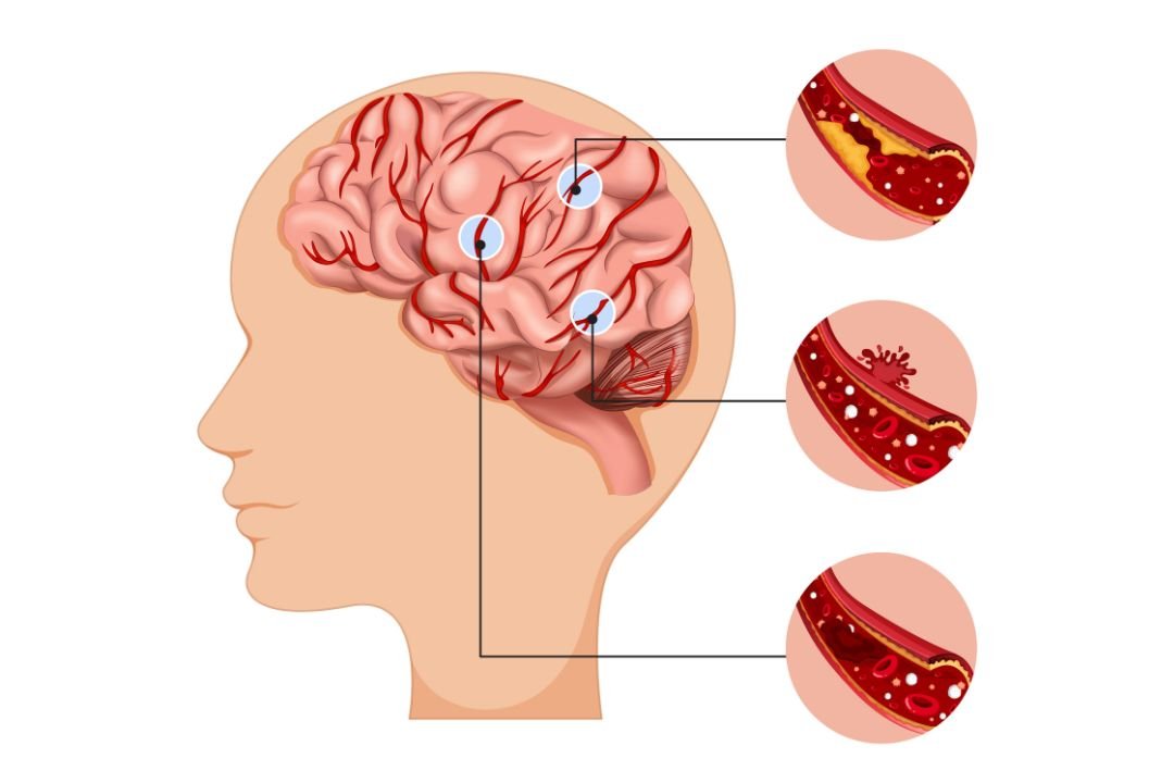Dampak Sistem Rujukan terhadap Penanganan Pasien Stroke di Indonesia