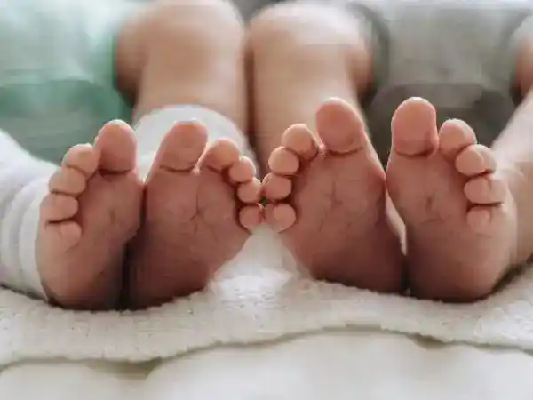 Pemulihan Bayi Kembar Siam Pascapemisahan: Kondisi Terbaru dan Perbedaan Kebutuhan Medis